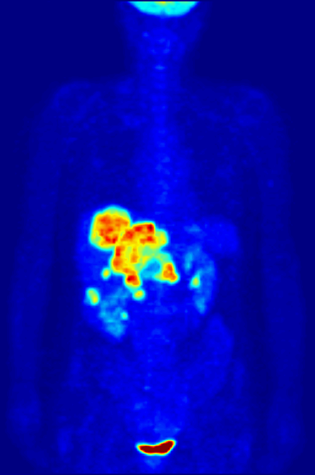 PET-Scan von Tumoren